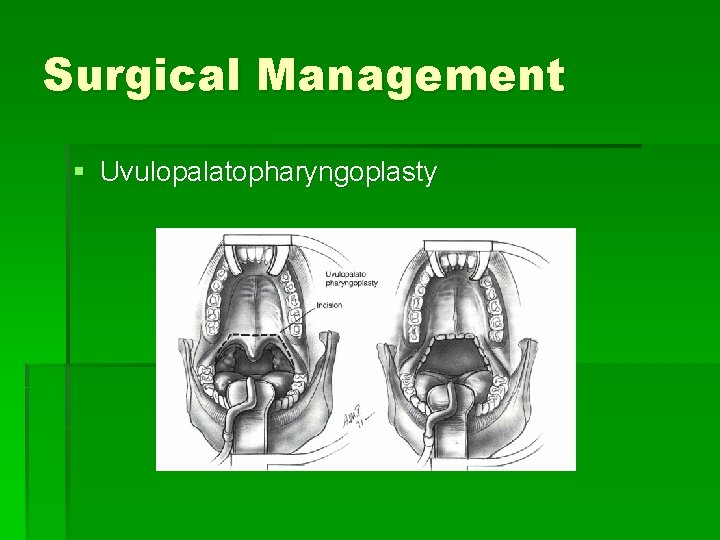 Surgical Management § Uvulopalatopharyngoplasty 