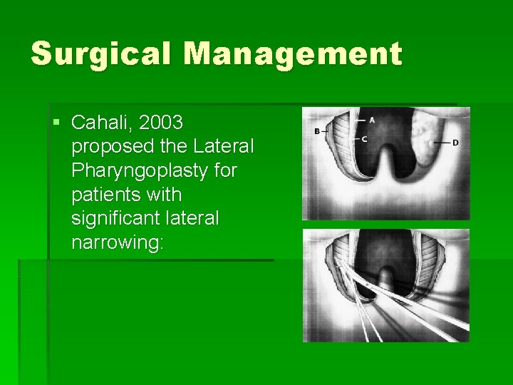 Surgical Management § Cahali, 2003 proposed the Lateral Pharyngoplasty for patients with significant lateral