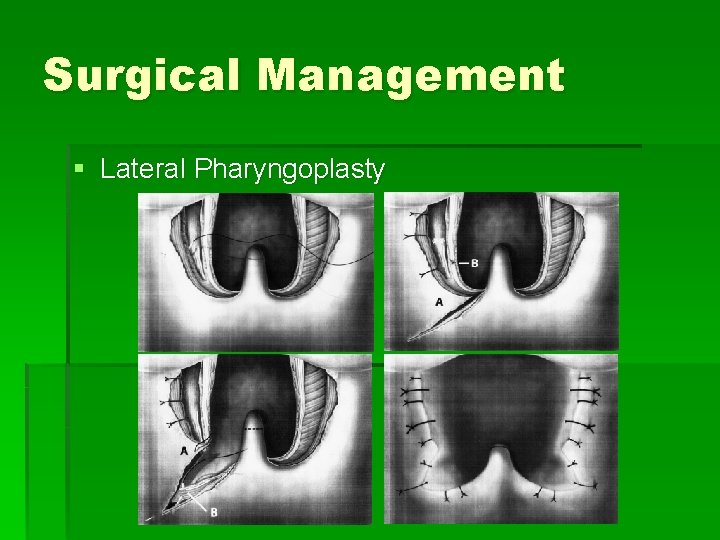 Surgical Management § Lateral Pharyngoplasty 
