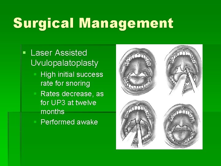 Surgical Management § Laser Assisted Uvulopalatoplasty § High initial success rate for snoring §