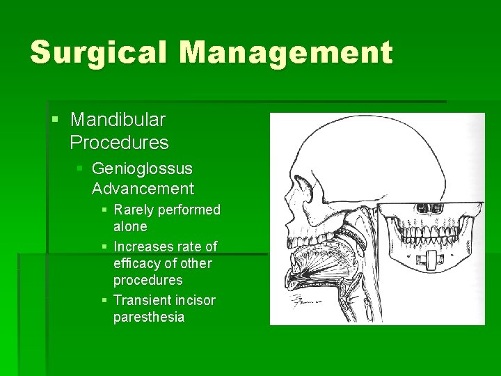 Surgical Management § Mandibular Procedures § Genioglossus Advancement § Rarely performed alone § Increases