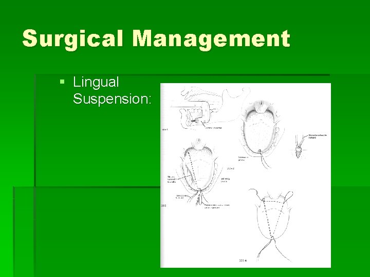 Surgical Management § Lingual Suspension: 