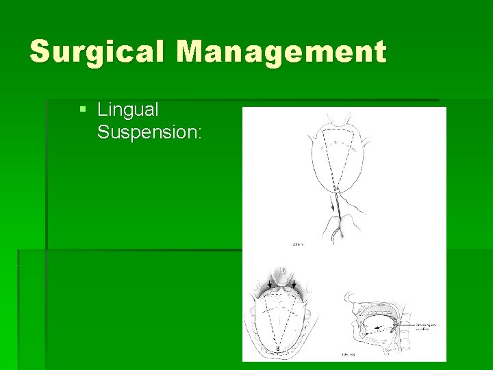 Surgical Management § Lingual Suspension: 