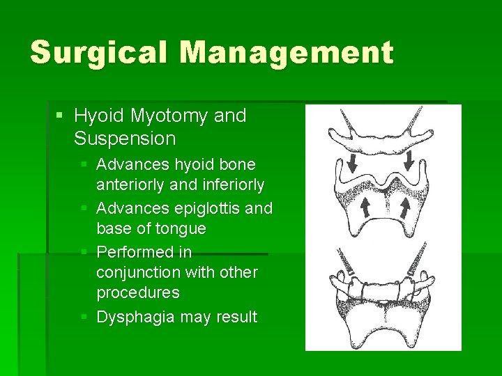 Surgical Management § Hyoid Myotomy and Suspension § Advances hyoid bone anteriorly and inferiorly