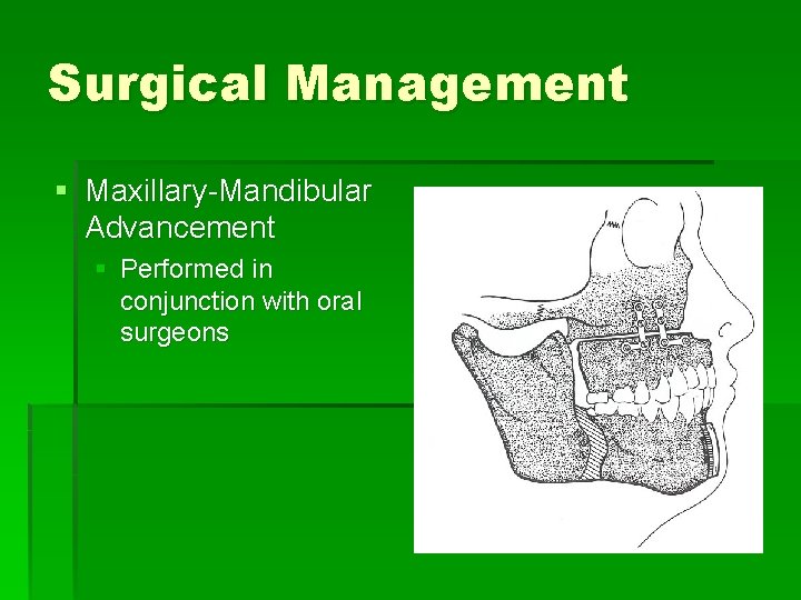 Surgical Management § Maxillary-Mandibular Advancement § Performed in conjunction with oral surgeons 