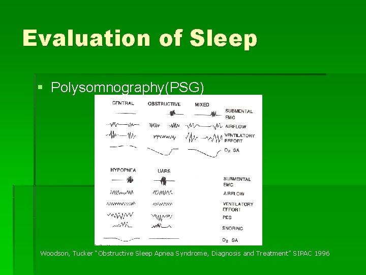 Evaluation of Sleep § Polysomnography(PSG) Woodson, Tucker “Obstructive Sleep Apnea Syndrome, Diagnosis and Treatment”