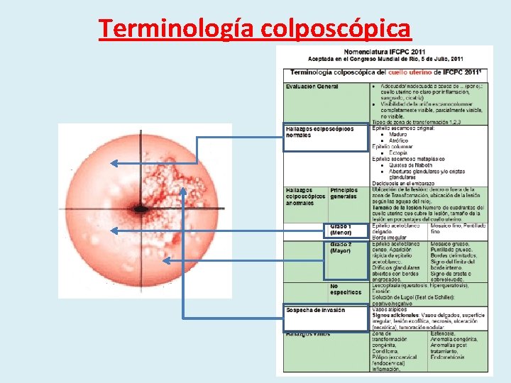 Terminología colposcópica 