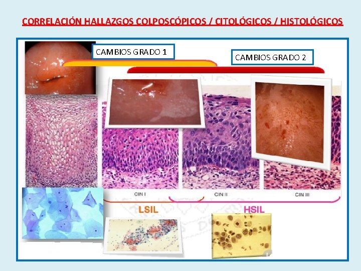 CORRELACIÓN HALLAZGOS COLPOSCÓPICOS / CITOLÓGICOS / HISTOLÓGICOS CAMBIOS GRADO 1 CAMBIOS GRADO 2 