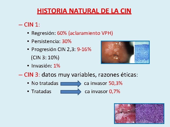 HISTORIA NATURAL DE LA CIN – CIN 1: • Regresión: 60% (aclaramiento VPH) •