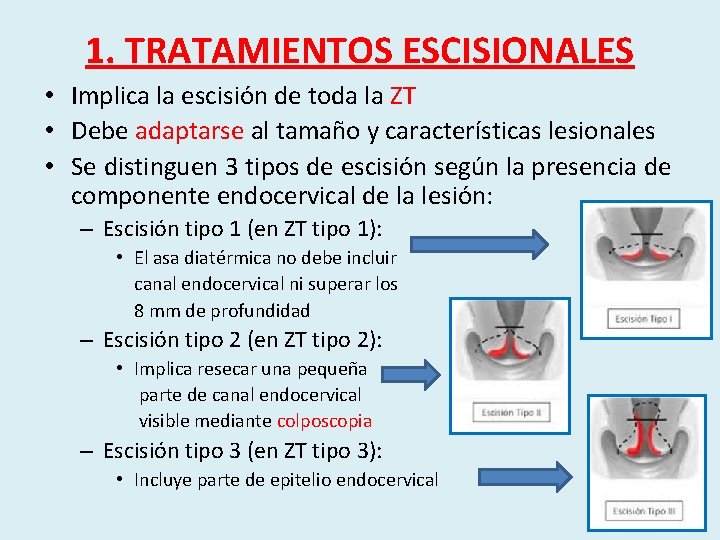 1. TRATAMIENTOS ESCISIONALES • Implica la escisión de toda la ZT • Debe adaptarse