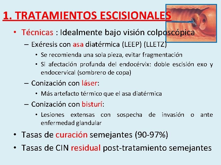 1. TRATAMIENTOS ESCISIONALES • Técnicas : Idealmente bajo visión colposcópica – Exéresis con asa