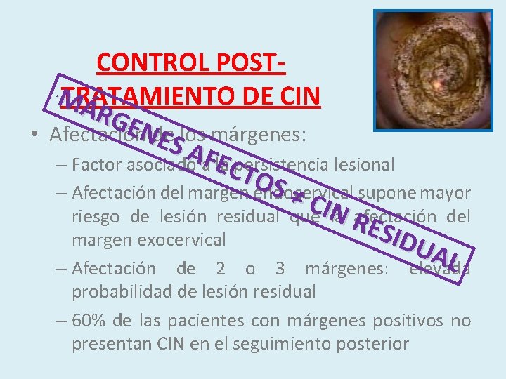 CONTROL POST´M TRATAMIENTO DE CIN ÁRG ENde • Afectación márgenes: ESlos A – Factor