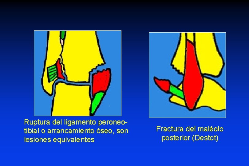 Ruptura del ligamento peroneotibial o arrancamiento óseo, son lesiones equivalentes Fractura del maléolo posterior Ruptura del ligamento peroneotibial o arrancamiento óseo, son lesiones equivalentes Fractura del maléolo posterior
