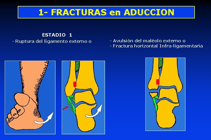 1 - FRACTURAS en ADUCCION ESTADIO 1 - Ruptura del ligamento externo o -