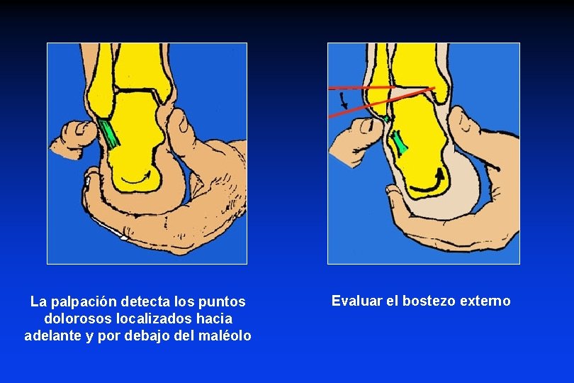 La palpación detecta los puntos dolorosos localizados hacia adelante y por debajo del maléolo