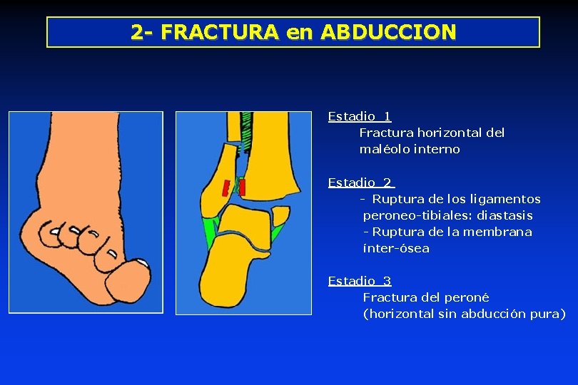 2 - FRACTURA en ABDUCCION Estadio 1 Fractura horizontal del maléolo interno Estadio 2