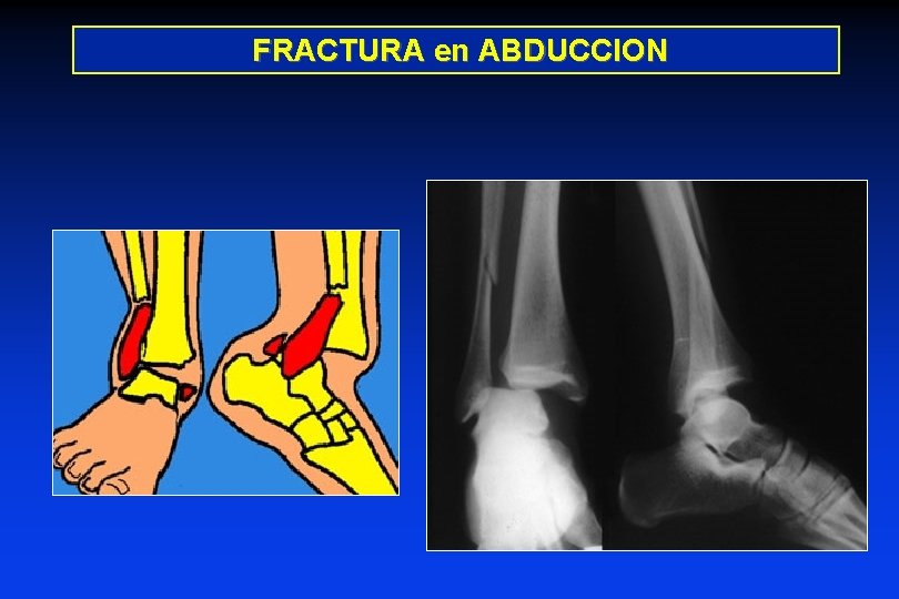 FRACTURA en ABDUCCION 