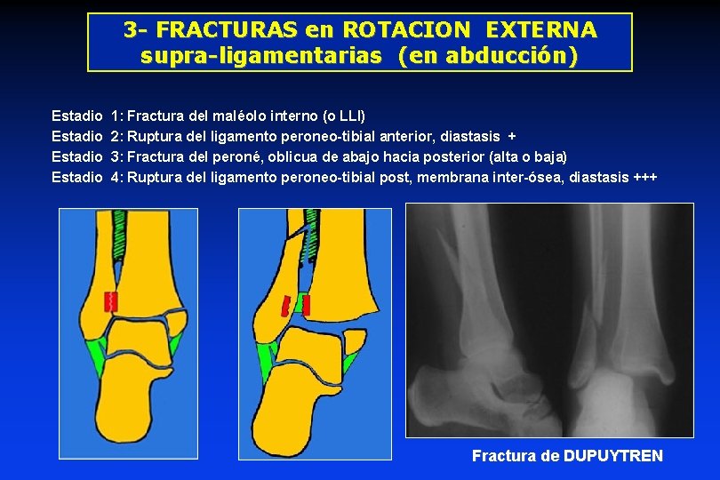 3 - FRACTURAS en ROTACION EXTERNA supra-ligamentarias (en abducción) Estadio 1: Fractura del maléolo 3 - FRACTURAS en ROTACION EXTERNA supra-ligamentarias (en abducción) Estadio 1: Fractura del maléolo