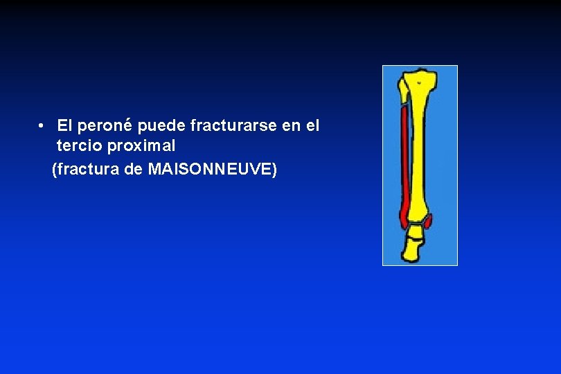  • El peroné puede fracturarse en el tercio proximal (fractura de MAISONNEUVE) 