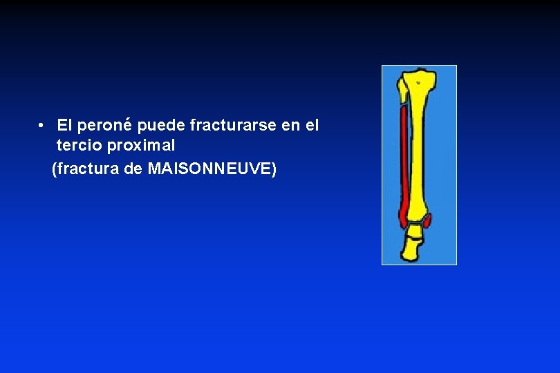 • El peroné puede fracturarse en el tercio proximal (fractura de MAISONNEUVE) • El peroné puede fracturarse en el tercio proximal (fractura de MAISONNEUVE)
