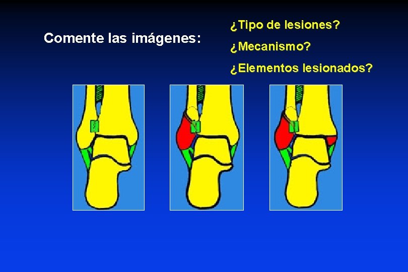 Comente las imágenes: ¿Tipo de lesiones? ¿Mecanismo? ¿Elementos lesionados? Comente las imágenes: ¿Tipo de lesiones? ¿Mecanismo? ¿Elementos lesionados?