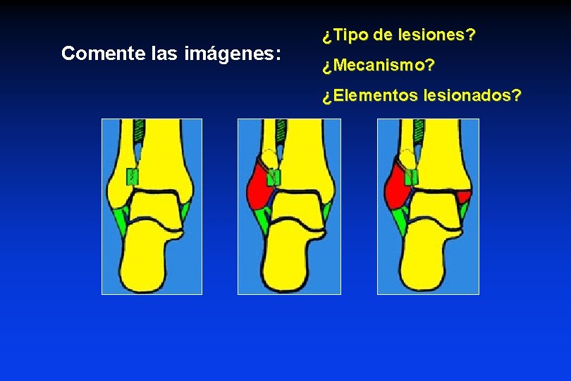 Comente las imágenes: ¿Tipo de lesiones? ¿Mecanismo? ¿Elementos lesionados? 