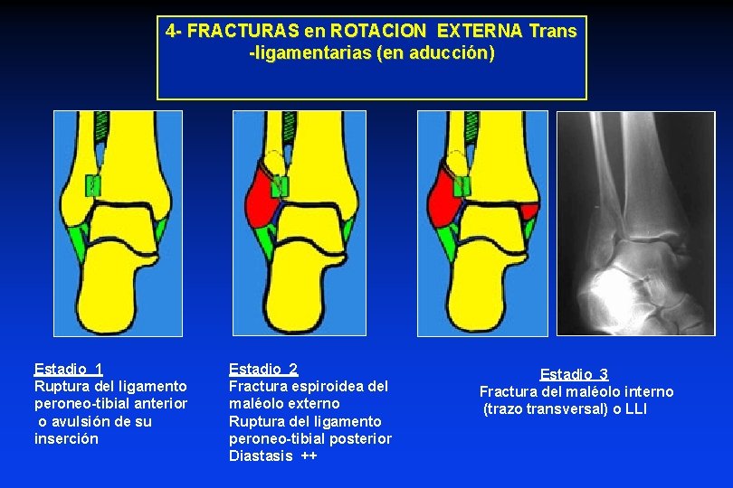 4 - FRACTURAS en ROTACION EXTERNA Trans -ligamentarias (en aducción) Estadio 1 Ruptura del
