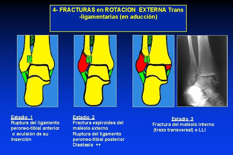 4 - FRACTURAS en ROTACION EXTERNA Trans -ligamentarias (en aducción) Estadio 1 Ruptura del 4 - FRACTURAS en ROTACION EXTERNA Trans -ligamentarias (en aducción) Estadio 1 Ruptura del