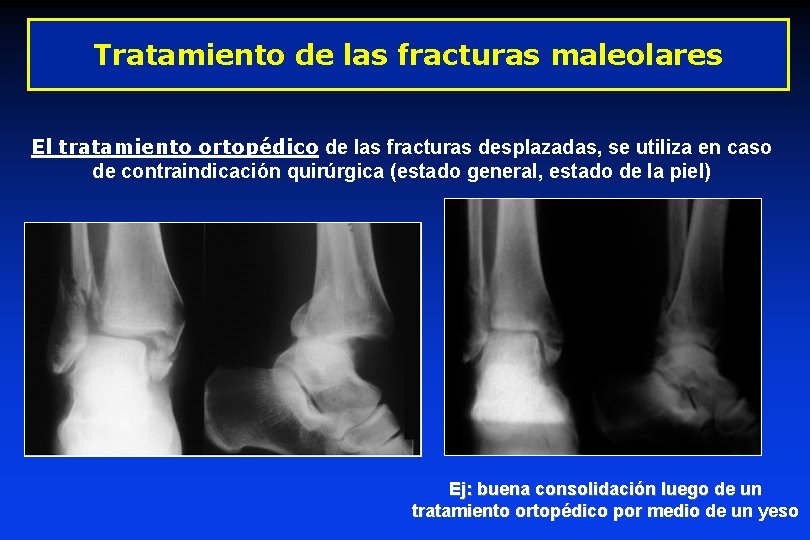 Tratamiento de las fracturas maleolares El tratamiento ortopédico de las fracturas desplazadas, se utiliza