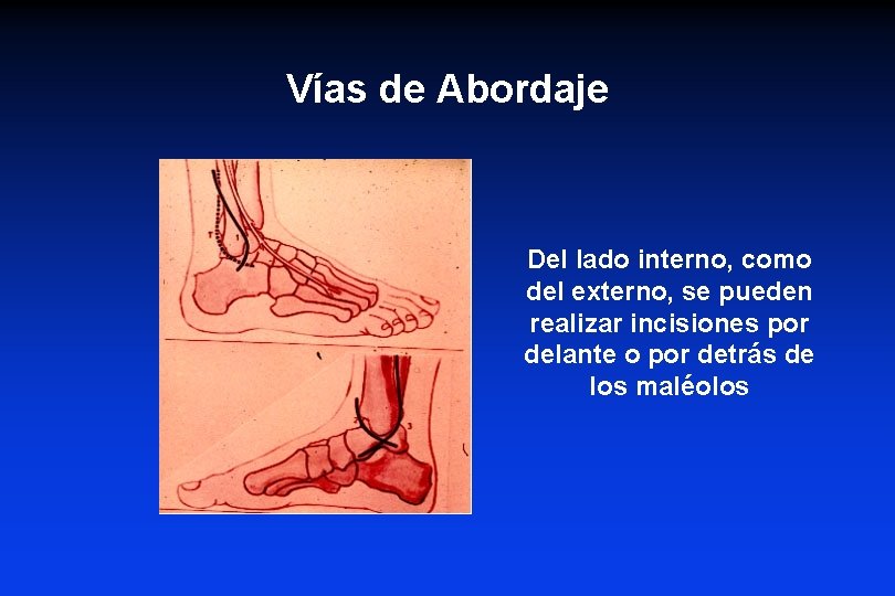 Vías de Abordaje Del lado interno, como del externo, se pueden realizar incisiones por Vías de Abordaje Del lado interno, como del externo, se pueden realizar incisiones por