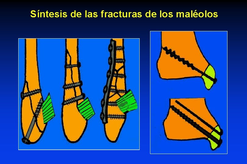 Síntesis de las fracturas de los maléolos Síntesis de las fracturas de los maléolos