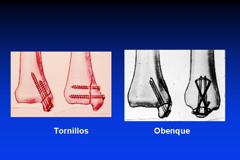 Tornillos Obenque 