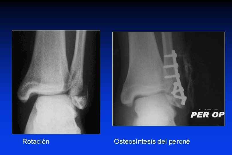 Rotación Osteosíntesis del peroné Rotación Osteosíntesis del peroné