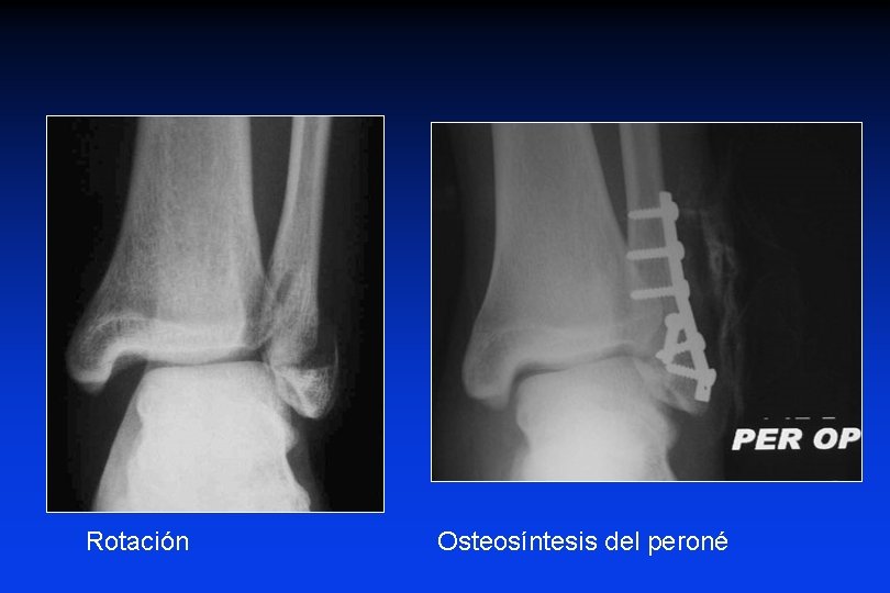 Rotación Osteosíntesis del peroné 