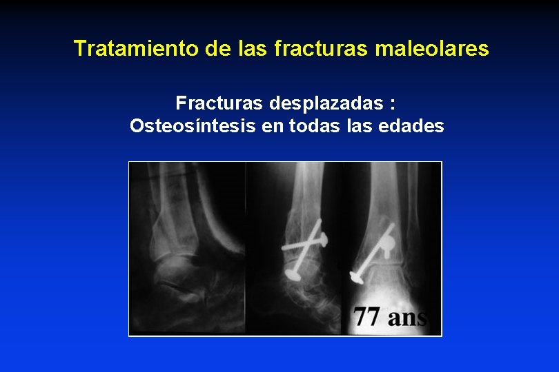 Tratamiento de las fracturas maleolares Fracturas desplazadas : Osteosíntesis en todas las edades Tratamiento de las fracturas maleolares Fracturas desplazadas : Osteosíntesis en todas las edades
