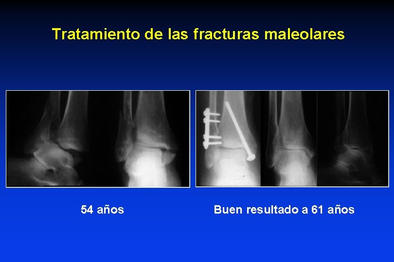 Tratamiento de las fracturas maleolares 54 años Buen resultado a 61 años 