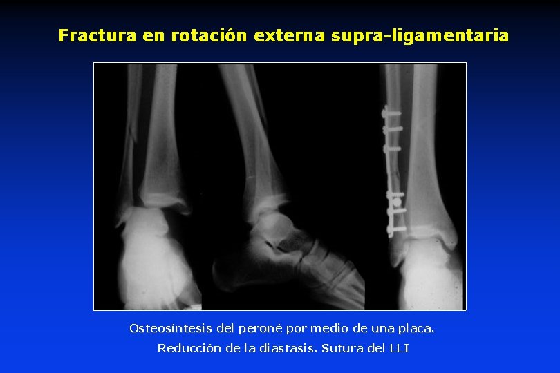 Fractura en rotación externa supra-ligamentaria Osteosíntesis del peroné peron por medio de una placa. Fractura en rotación externa supra-ligamentaria Osteosíntesis del peroné peron por medio de una placa.