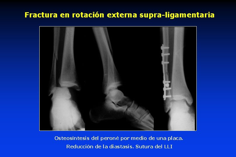 Fractura en rotación externa supra-ligamentaria Osteosíntesis del peroné peron por medio de una placa.