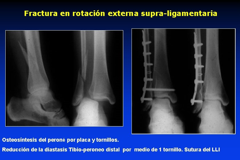 Fractura en rotación externa supra-ligamentaria Osteosíntesis del peroné por placa y tornillos. Reducción de