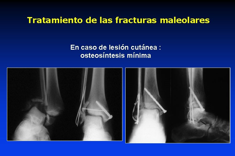 Tratamiento de las fracturas maleolares En caso de lesión cutánea : osteosíntesis mínima 