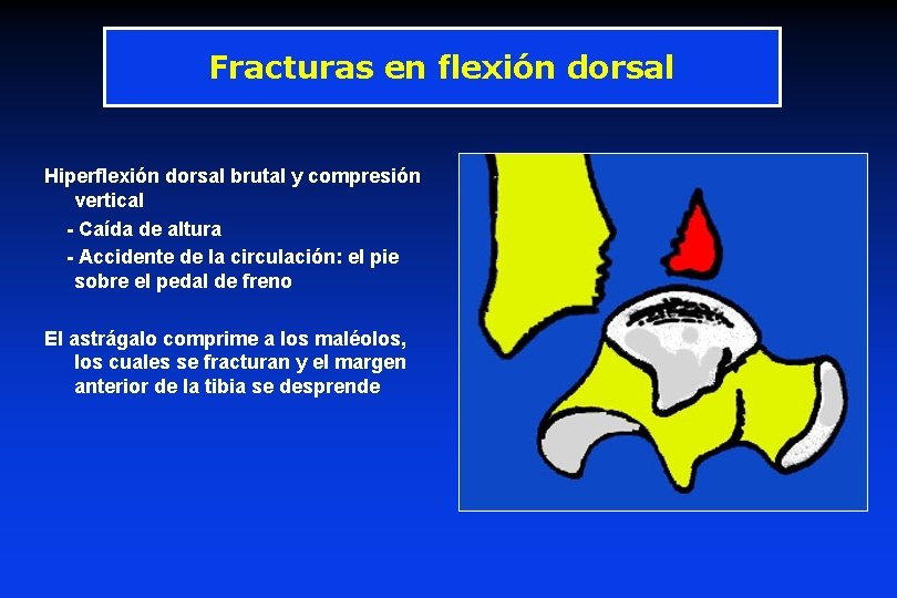 Fracturas en flexión dorsal Hiperflexión dorsal brutal y compresión vertical - Caída de altura