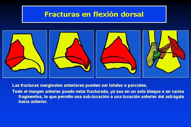 Fracturas en flexión dorsal Las fracturas marginales anteriores pueden ser totales o parciales. Todo