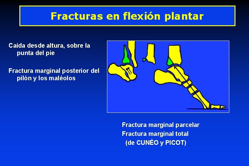 Fracturas en flexión plantar Caída desde altura, sobre la punta del pie Fractura marginal