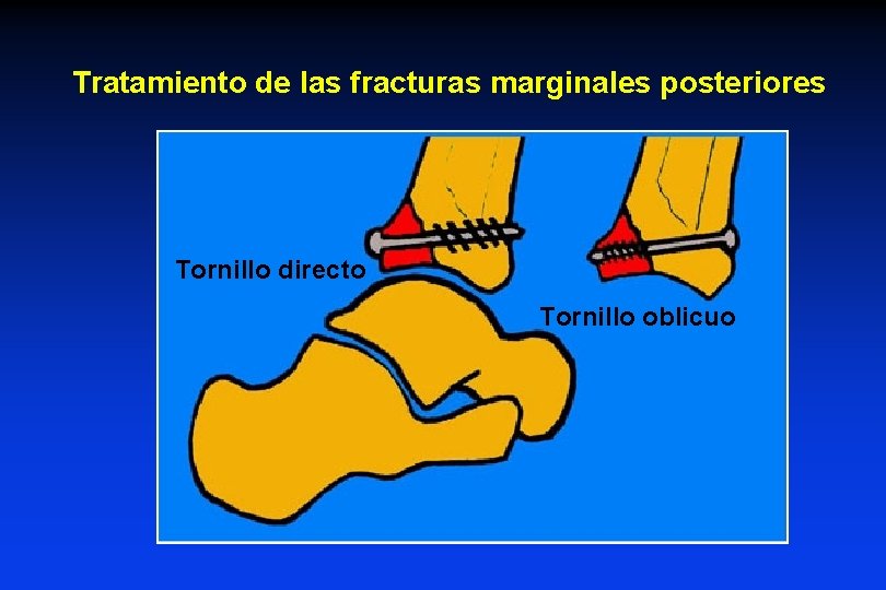 Tratamiento de las fracturas marginales posteriores Tornillo directo Tornillo oblicuo 
