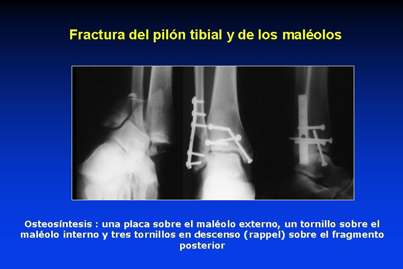 Fractura del pilón tibial y de los maléolos Osteosíntesis : una placa sobre el Fractura del pilón tibial y de los maléolos Osteosíntesis : una placa sobre el