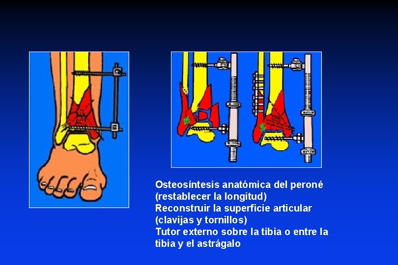 Osteosíntesis anatómica del peroné (restablecer la longitud) Reconstruir la superficie articular (clavijas y tornillos)
