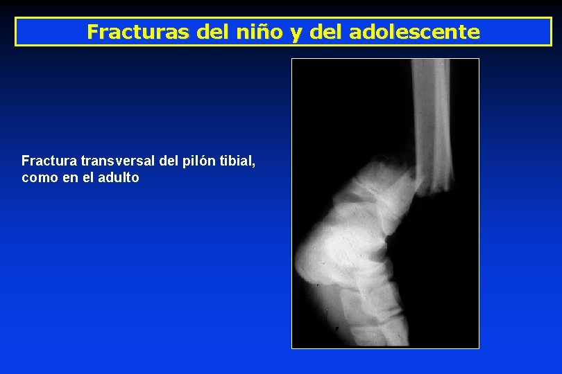 Fracturas del niño y del adolescente Fractura transversal del pilón tibial, como en el