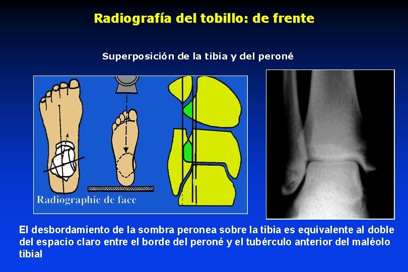 Radiografía del tobillo: de frente Superposición de la tibia y del peroné El desbordamiento