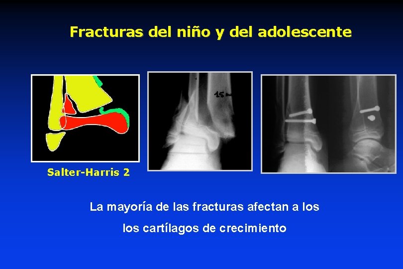Fracturas del niño y del adolescente 15 ans Salter-Harris 2 La mayoría de las Fracturas del niño y del adolescente 15 ans Salter-Harris 2 La mayoría de las