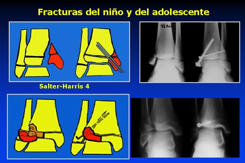 Fracturas del niño y del adolescente Salter-Harris 4 